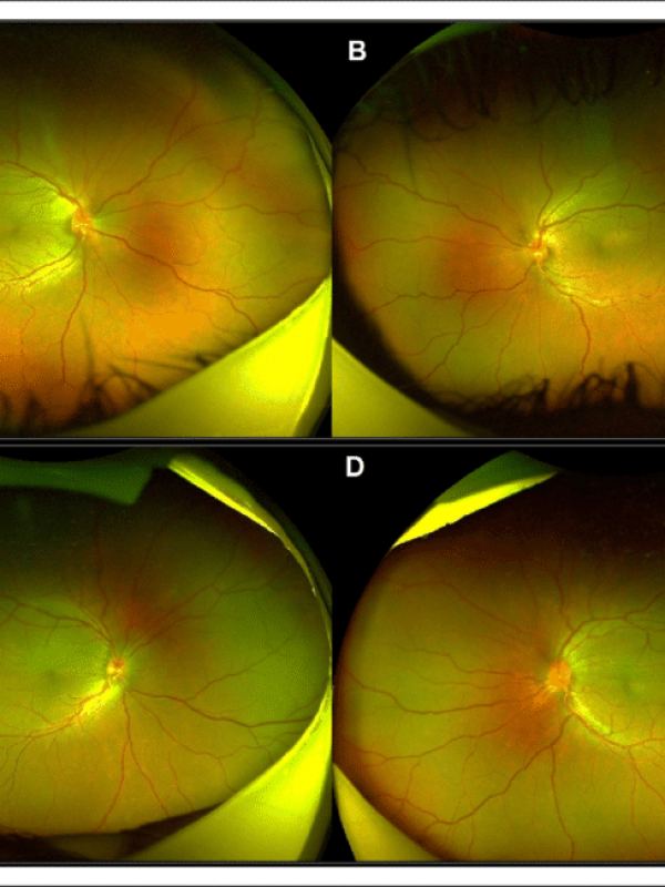 Wide-field-optomap-retinal-imaging-using-optosR-daytona-in-posterior-microphthalmos